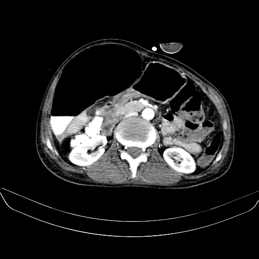 File:Abdominal collection due to previous cecal perforation (Radiopaedia 80831-94320 Axial C+ portal venous phase 87).jpg