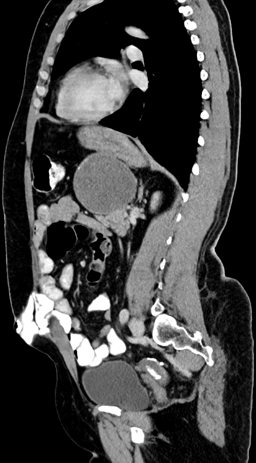 Abdominal hydatid disease (Radiopaedia 68223-77737 Sagittal C+ portal venous phase 28).jpg