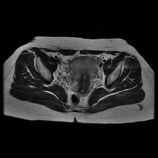 File:Abdominal wall endometriosis (Radiopaedia 83702-98847 Axial T2 9).jpg