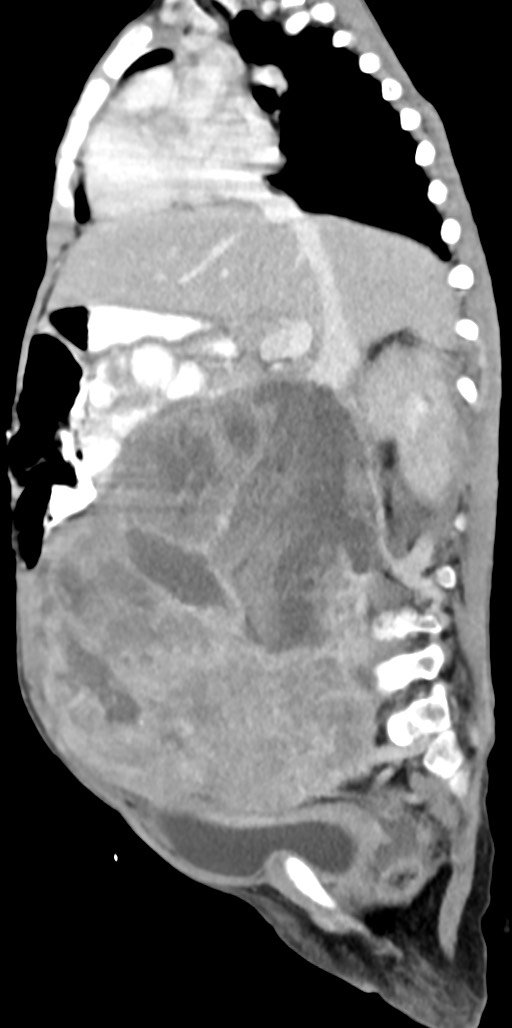 Abdominopelvic rhabdomyosarcoma (Radiopaedia 78356-90984 Sagittal C+ portal venous phase 53).jpg