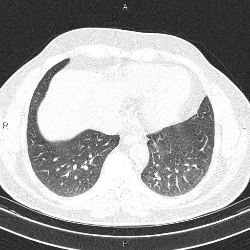 File:Aberrant right subclavian artery (Radiopaedia 87093-103354 Axial lung window 82).jpg