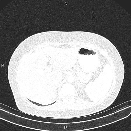 Aberrant right subclavian artery (Radiopaedia 87334-103629 Axial lung window 67).jpg