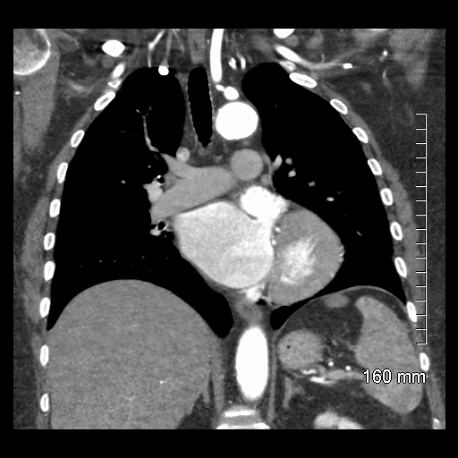 File:Aberrant right subclavian artery stenosis (Radiopaedia 52656-58670 B 48).jpg