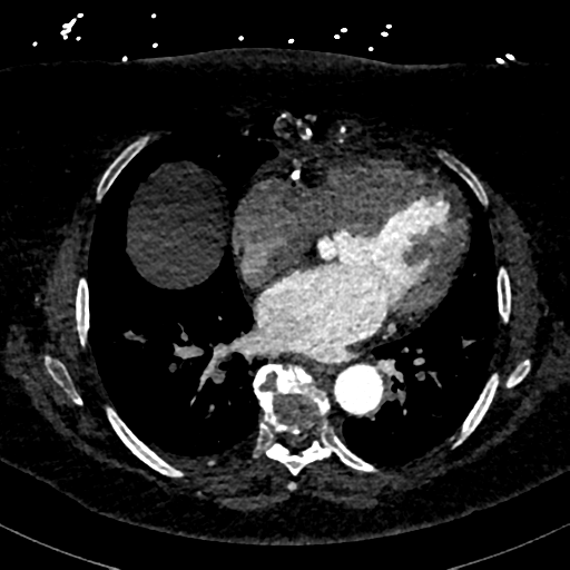 Aberrant right subclavian artery with Kommerell diverticulum (Radiopaedia 47982-52769 Axial C+ arterial phase 60).png