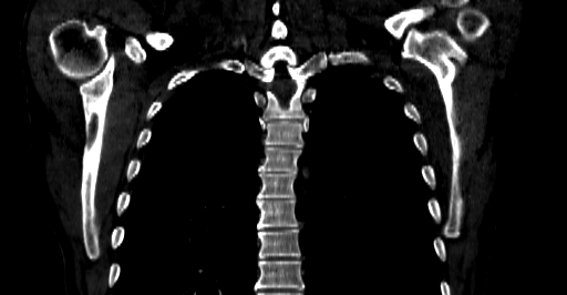 Accesory rib joint (Radiopaedia 71987-82452 Coronal bone window 36).jpg