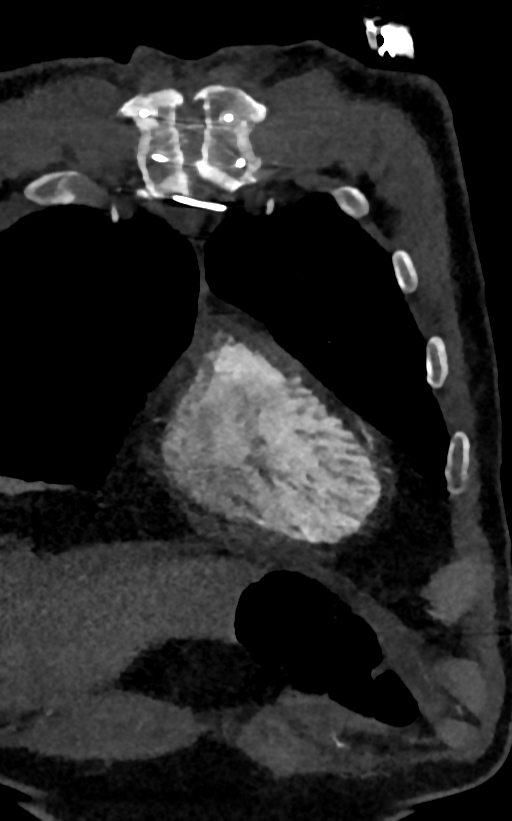 Accessory left atrial appendage (Radiopaedia 81987-95968 Coronal C+ arterial phase 4).jpg