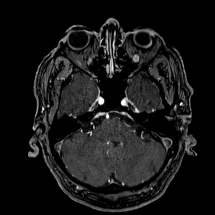 Accessory middle cerebral artery (Radiopaedia 73114-83828 Axial MRA 37).jpg