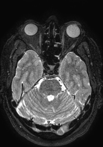 Accessory middle cerebral artery (Radiopaedia 73114-83828 Axial T2 144).jpg