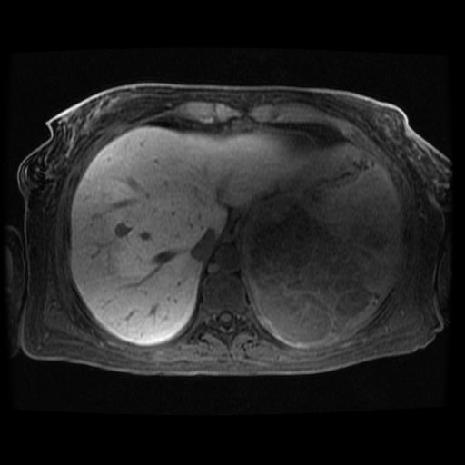 Acinar cell carcinoma of the pancreas (Radiopaedia 75442-86668 Axial late phase (~30 mins) 116).jpg
