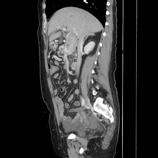 File:Acinar cell carcinoma of the pancreas (Radiopaedia 75442-86669 Sagittal C+ portal venous phase 80).jpg
