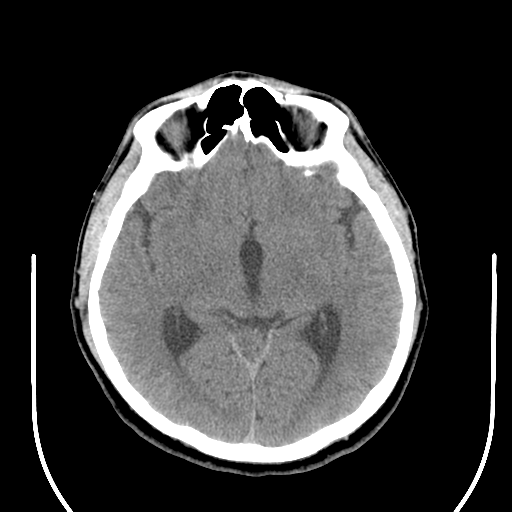 File:Acoustic schwannoma (Radiopaedia 39170-41388 Axial non-contrast 23).png