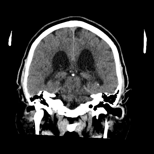 File:Acoustic schwannoma (Radiopaedia 55729-62280 Coronal non-contrast 25).png