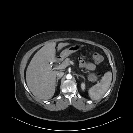 Acromioclavicular joint cyst (Radiopaedia 58455-65610 Axial C+ arterial phase 107).jpg