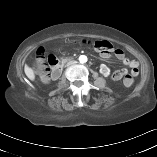 File:Active bleeding from duodenal ulcer with embolization (Radiopaedia 34216-35481 C 29).png