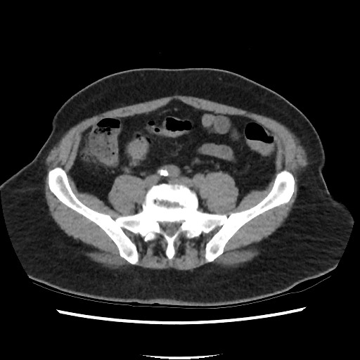 Active colonic bleed on CT (Radiopaedia 49765-55025 Axial non-contrast 58).jpg