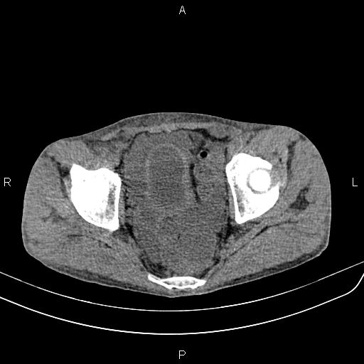 Active crohn disease (Radiopaedia 87133-103397 Axial non-contrast 92).jpg