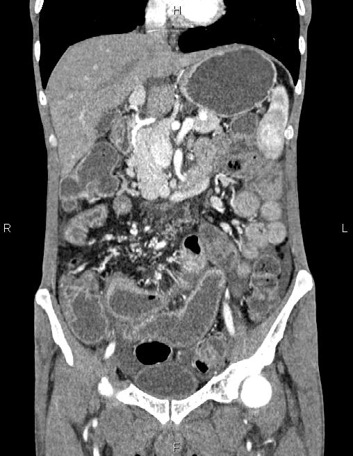 Active crohn disease (Radiopaedia 87133-103397 Coronal C+ arterial phase 26).jpg
