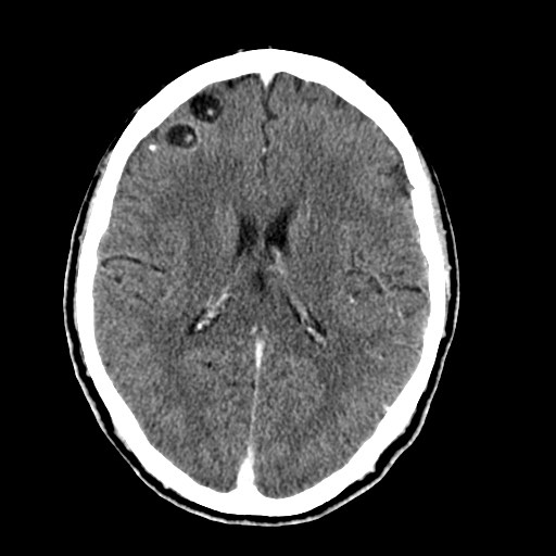 File:Active neurocysticercosis before and after therapy (Radiopaedia 71710-82099 Axial C+ delayed 42).jpg