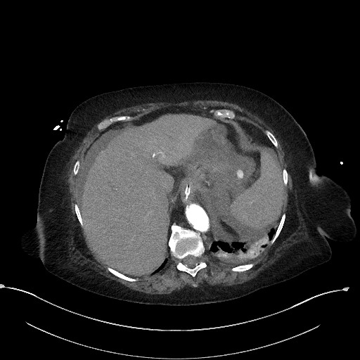 Active renal extravasation with large subcapsular and retroperitoneal hemorrhage (Radiopaedia 60975-68796 Axial C+ arterial phase 37).jpg