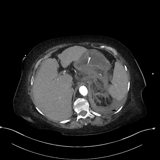 Active renal extravasation with large subcapsular and retroperitoneal hemorrhage (Radiopaedia 60975-68796 Axial C+ arterial phase 47).jpg