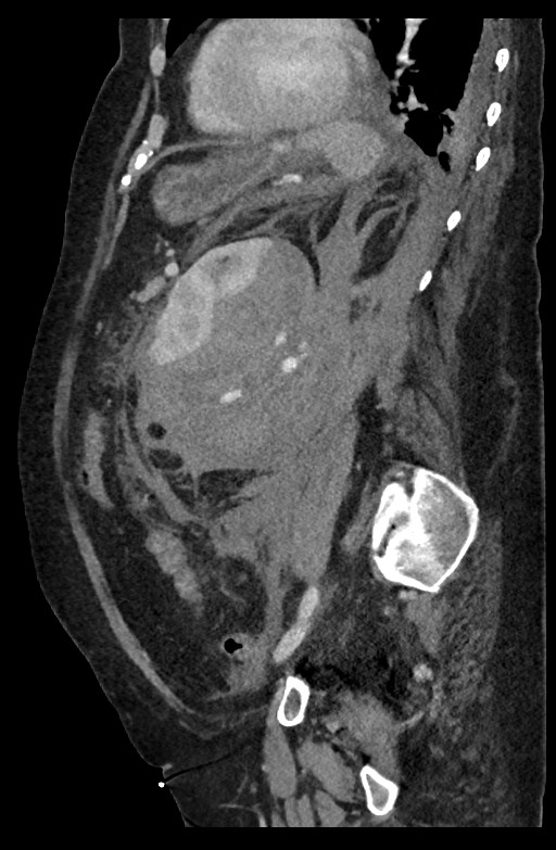 Active renal extravasation with large subcapsular and retroperitoneal hemorrhage (Radiopaedia 60975-68796 Sagittal C+ portal venous phase 86).jpg