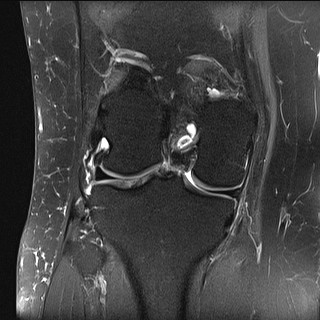 File:Acute-on-chronic transient lateral patellar dislocation with trochlear dysplasia (Radiopaedia 84099-99349 Coronal PD fat sat 17).jpg