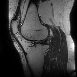 File:Acute-on-chronic transient lateral patellar dislocation with trochlear dysplasia (Radiopaedia 84099-99349 Sagittal PD 102).jpg