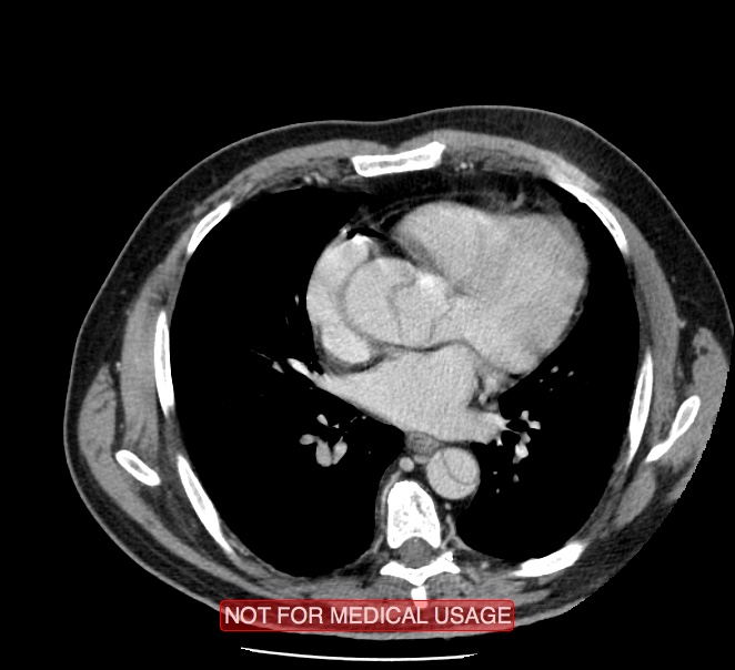 Acute aortic dissection - Stanford type A (Radiopaedia 40661-43285 Axial C+ portal venous phase 32).jpg