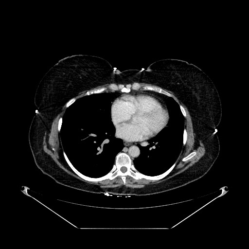 Acute appendicitis, heterotaxy syndrome (Radiopaedia 66884-76202 Axial C+ portal venous phase 3).jpg