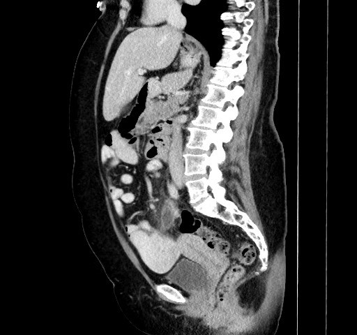 Acute appendicitis, heterotaxy syndrome (Radiopaedia 66884-76202 Sagittal C+ portal venous phase 65).jpg
