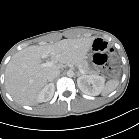 File:Acute appendicitis (Radiopaedia 32614-33572 Axial C+ portal venous phase 15).jpg