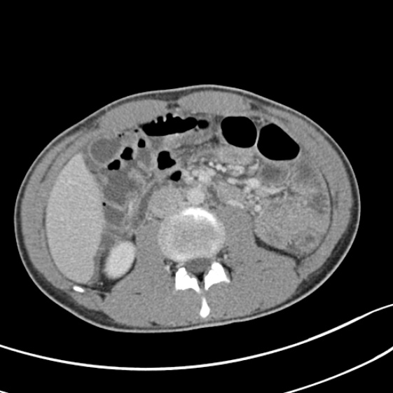 Acute appendicitis (Radiopaedia 32614-33572 Axial C+ portal venous phase 29).jpg
