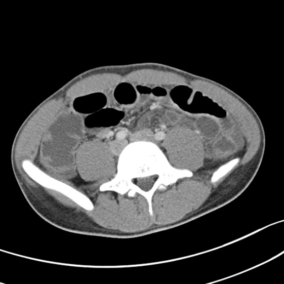 Acute appendicitis (Radiopaedia 32614-33572 Axial C+ portal venous phase 42).jpg