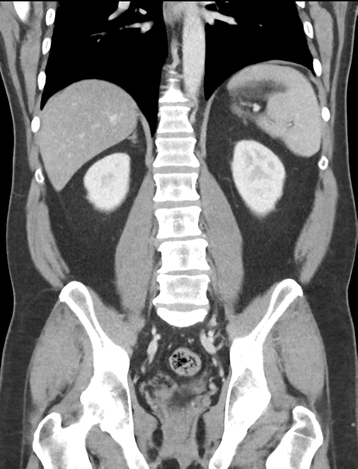 Acute appendicitis (Radiopaedia 36611-38177 Coronal C+ portal venous phase 42).png