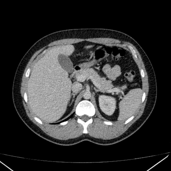 Acute appendicitis (Radiopaedia 38255-40270 Axial C+ portal venous phase 28).jpg