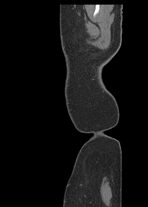 Acute appendicitis (Radiopaedia 48511-53463 Sagittal C+ portal venous phase 10).jpg