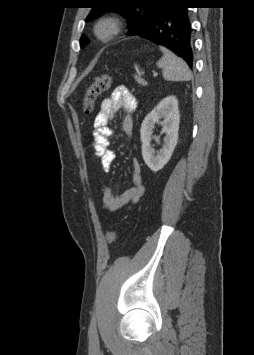 Acute appendicitis (Radiopaedia 48511-53463 Sagittal C+ portal venous phase 101).jpg