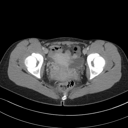 File:Acute appendicitis (Radiopaedia 62608-70901 Axial C+ portal venous phase 49).jpg