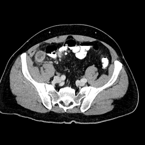 Acute appendicitis (Radiopaedia 77016-88960 Axial C+ portal venous phase 109).jpg