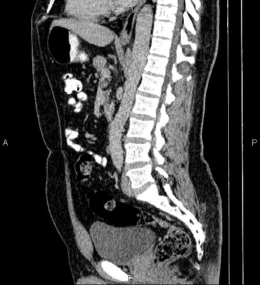 Acute appendicitis (Radiopaedia 84780-100240 Sagittal C+ portal venous phase 55).jpg
