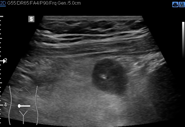 File:Acute appendicitis (Radiopaedia 85193-100745 D 175).jpg