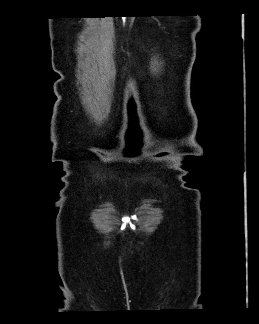 Acute appendicitis - large appendicoliths (Radiopaedia 61805-69820 Coronal C+ portal venous phase 129).jpg