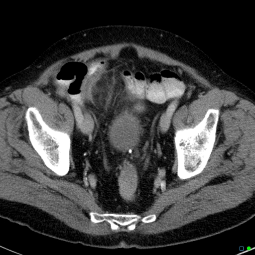 File:Acute appendicitis arising from a malrotated cecum (Radiopaedia 19970-19997 Axial C+ portal venous phase 42).jpg