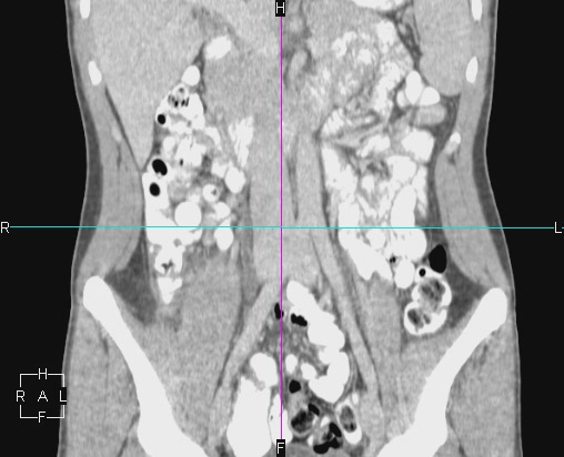File:Acute appendicitis with CT arrowhead sign (Radiopaedia 21474-21411 Coronal C+ portal venous phase 11).JPG
