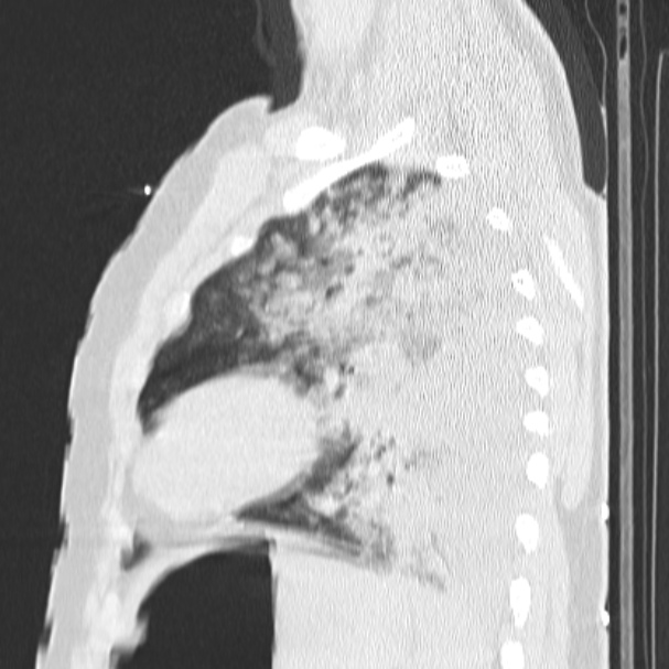 Acute aspiration pneumonitis (Radiopaedia 33605-34703 Sagittal lung window 64).jpg