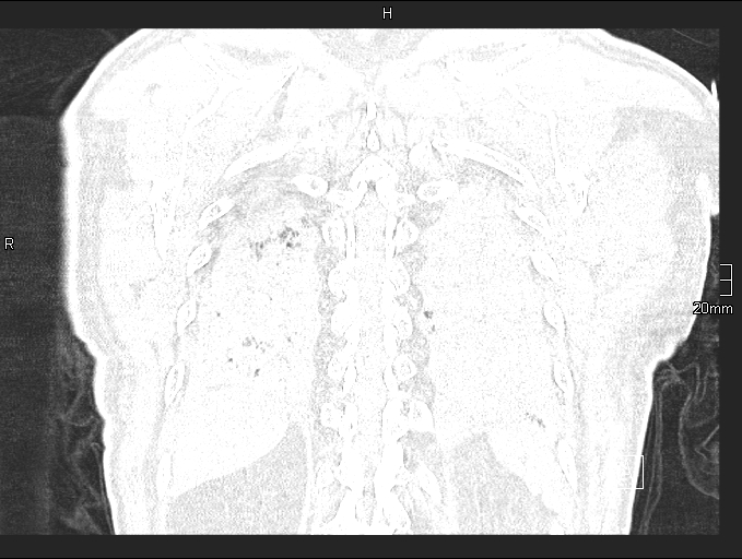 Acute aspiration pneumonitis (Radiopaedia 55642-62166 Coronal lung window 90).jpg