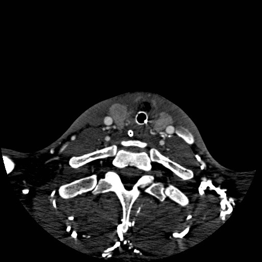 Acute basilar artery occlusion (Radiopaedia 43582-46985 Axial C+ arterial phase 264).jpg