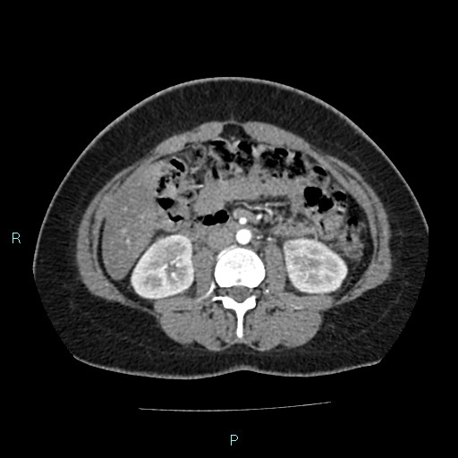 File:Acute bilateral pyelonephritis (Radiopaedia 37146-38881 Axial C+ arterial phase 93).jpg