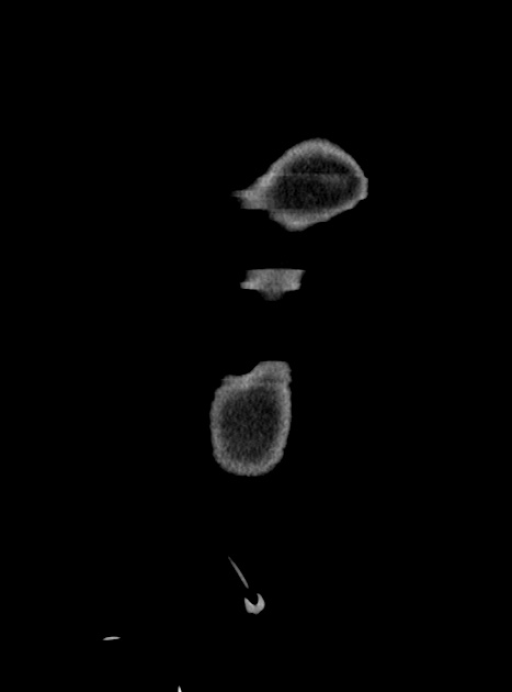 Acute bowel ischemia (Radiopaedia 87695-104114 Coronal C+ portal venous phase 49).jpg