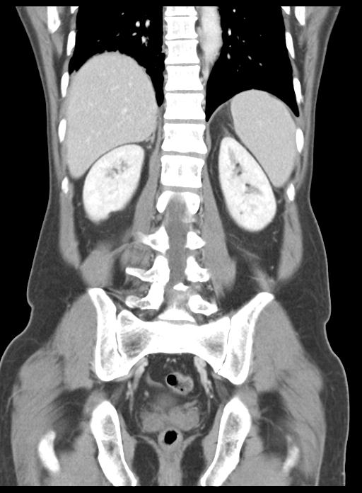 Acute cholecystitis (Radiopaedia 29814-30327 Coronal C+ portal venous phase 38).jpg